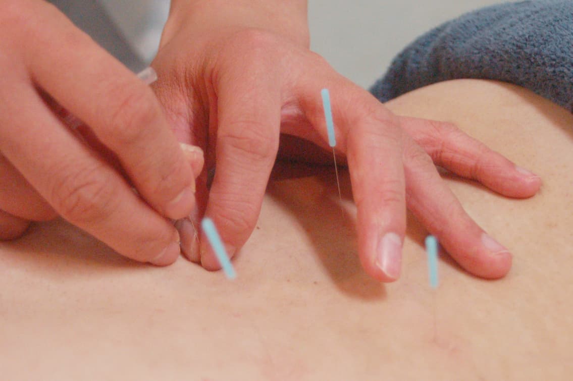 鍼灸(はりきゅう)イメージ